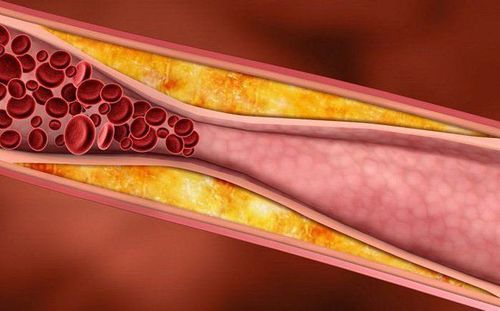 Causes of coronary atherosclerosis