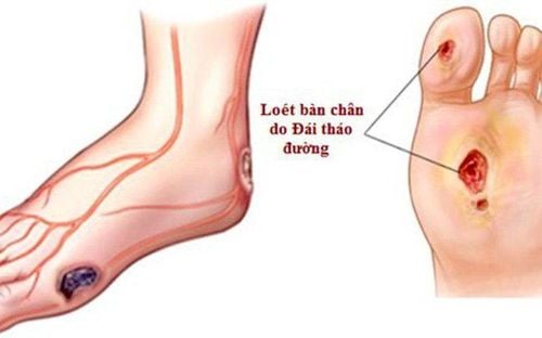 
Tổn thương dây thần kinh ở bàn chân hoặc lưu lượng máu đến bàn chân kém làm tăng nguy cơ biến chứng ở bàn chân
