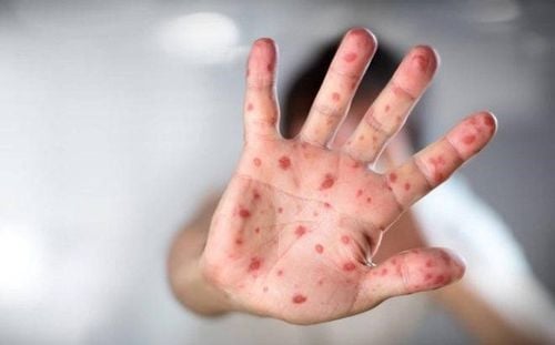 
Việc nhiễm virus nhóm Enterovirus bao gồm bệnh tay chân miệng là hiện tượng phổ biến ở phụ nữ mang thai
