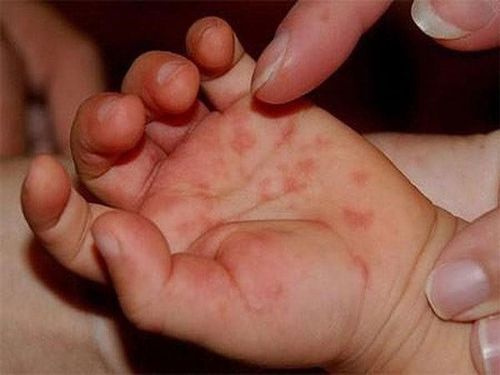 Hand, foot and mouth disease superinfection: The blister changes from clear to cloudy