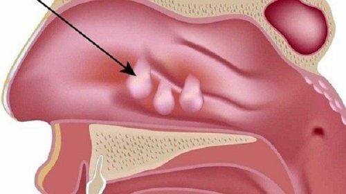 Measures to treat nasal polyps