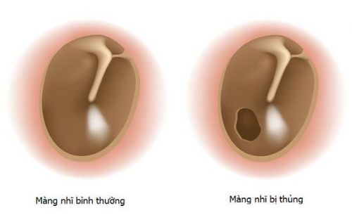 
Picture of a punctured eardrum
