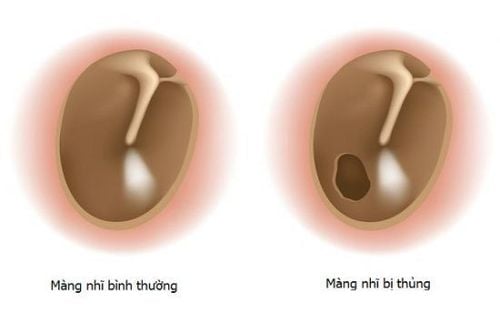 
Image of normal eardrum and perforated eardrum
