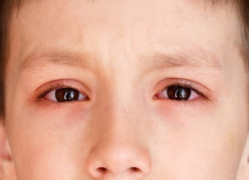 Causes and progression of pink eye in children