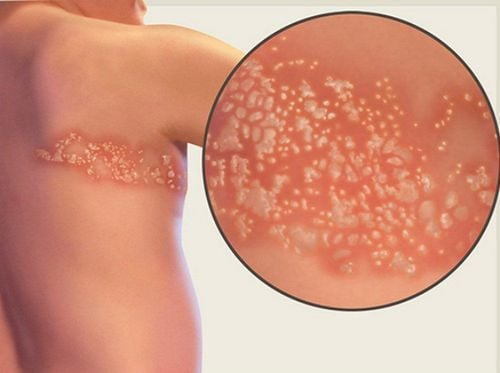 Is shingles contagious? How to treat?