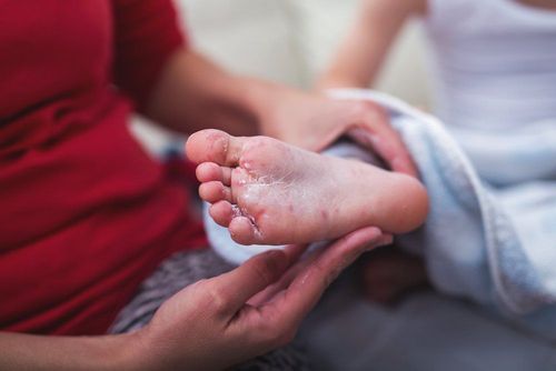 How did your child get hand, foot and mouth disease?