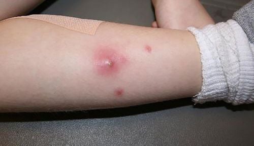 Learn about infectious dermatitis (purulent dermatitis)