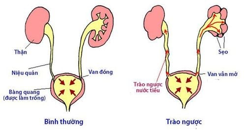 
Bệnh trào ngược bàng quang niệu quản
