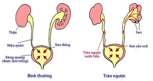 Chẩn đoán và điều trị chứng trào ngược bàng quang niệu quản