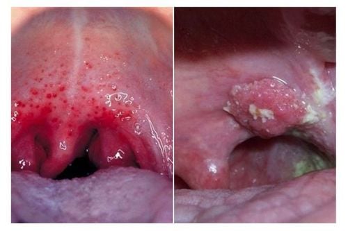 
Picture of throat fungus
