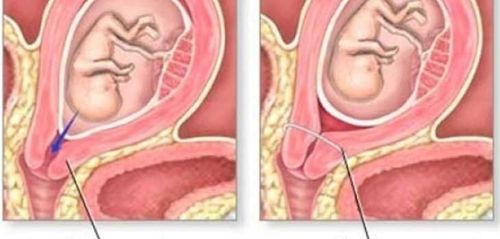 Stitching rings to narrow the cervical opening