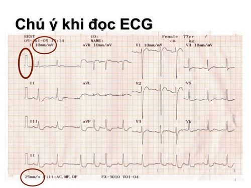 
Kết quả xét nghiệm điện tâm đồ
