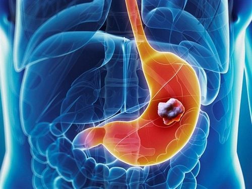 Gastric mucosal biopsy to diagnose gastric cancer