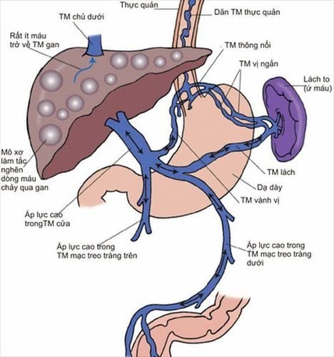 Esophageal varices in patients with cirrhosis