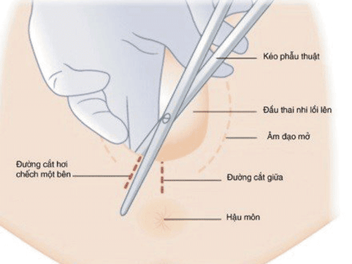 Incision and suture of the perineum during vaginal birth