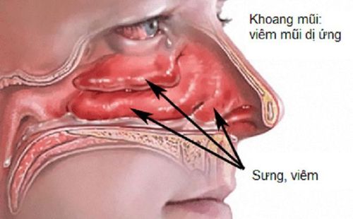 Viêm mũi dị ứng tuy không làm ảnh hưởng nghiêm trọng đến sức khỏe của bạn nhưng chúng gây ra cảm giác khó chịu