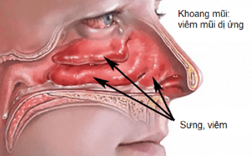 Gây mê mask thanh quản phẫu thuật nội soi cắt u xơ vòm mũi