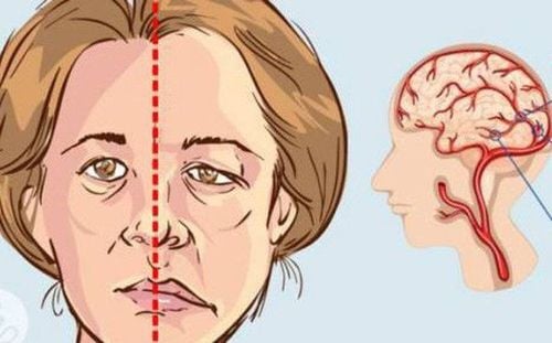 Rehabilitation after cerebrovascular accident