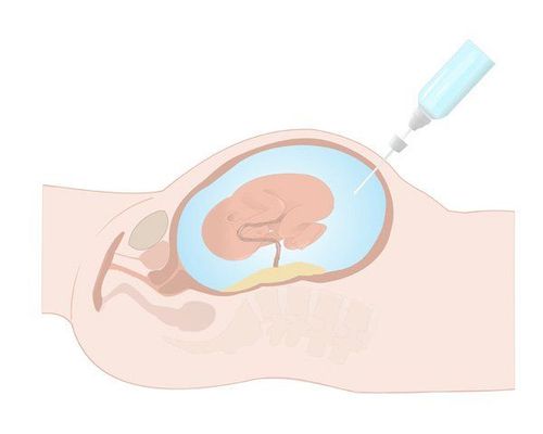 Is amniocentesis dangerous?