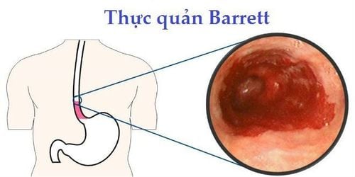 Barrett's esophagus - "acquaintance" of gastroesophageal reflux