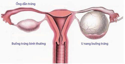 Learn about benign ovarian cysts