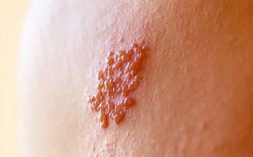 How are chickenpox and shingles related?