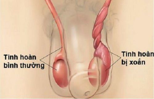 
Xoắn tinh hoàn là bệnh lý là nguy hiểm nhất vì có thể gây tổn thương tinh hoàn không hồi phục
