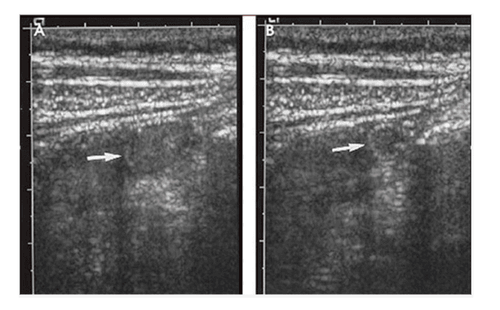 
Hình 1: Hình ảnh ruột thừa bình thường trên siêu âm (mũi tên): (a) mặt cắt trục ngắn đường kính dưới 6mm. (b) mặt cắt trục ngắn, ép đường kính nhỏ lại 5mm.
