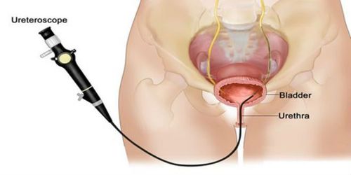 Laparoscopic bladder tumor removal