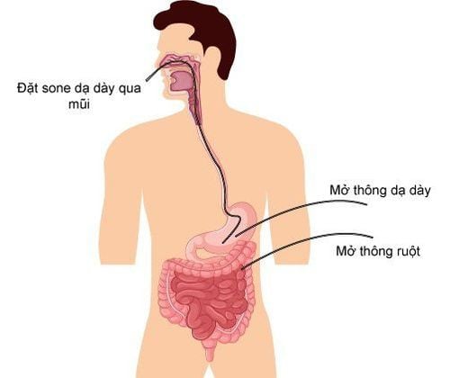 Open gastric bypass to nourish patients with esophageal cancer