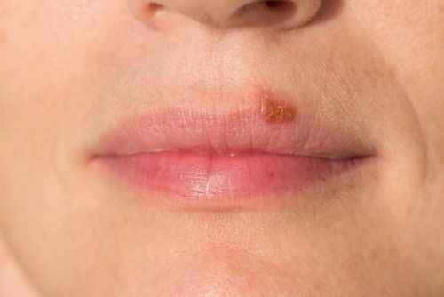 Note when applying home remedies for mouth sores