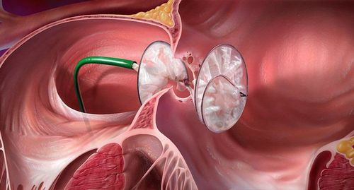 Possible complications after closure of secondary atrial septal defect