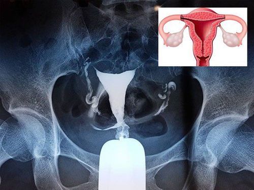 What is the purpose of an X-ray of the uterus and fallopian tubes?