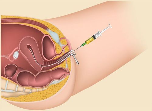 
Thụ tinh nhân tạo tăng hi vọng mang thai cho vợ chồng hiếm muộn
