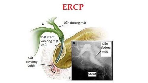 Ưu điểm của nội soi mật tụy ngược dòng (ERCP)