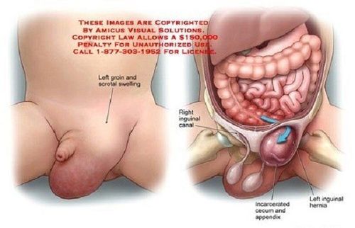 
Hình ảnh: thoát vị bẹn nhìn từ bân ngoài và bên trong
