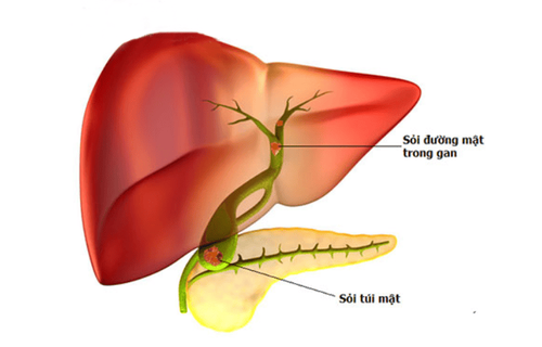 Do gallstones increase liver enzymes?