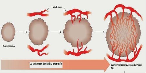 
Sự hình thành khối u
