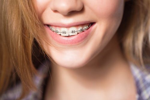 Braces have how many stages?