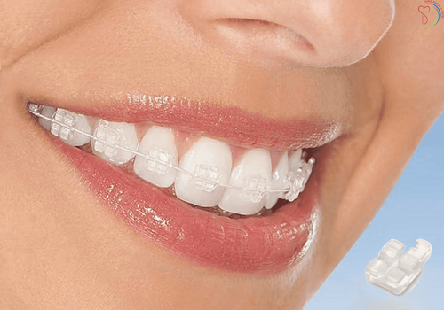 Ceramic braces and what you need to know