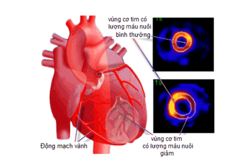 
Chụp xạ hình tưới máu cơ tim được thực hiện rất đa dạng
