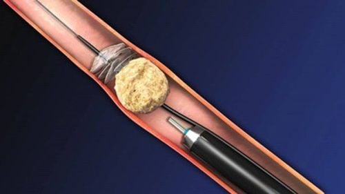 Endoscopic retrograde laser lithotripsy at Vinmec: Less pain, quick recovery