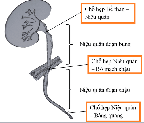 
Hình ảnh hẹp niệu quản
