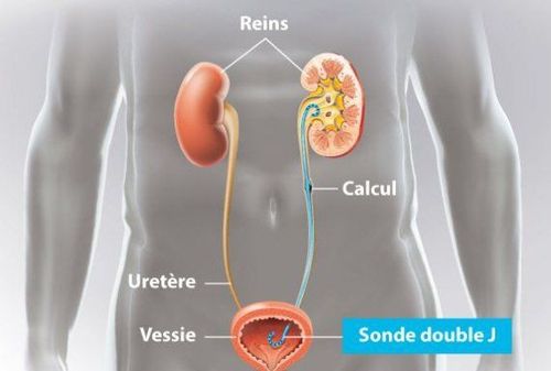 Ureteral stenting (Double-J) under enhanced radiography, treatment of ureteral stricture