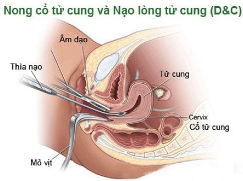 
Nong nạo cổ tử cung
