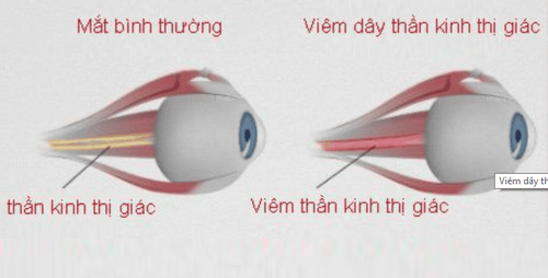 
Hình ảnh viêm dây thần kinh thị giác
