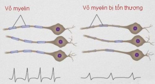 
Trong viêm dây thần kinh thị giác, các myelin bị viêm và tổn thương
