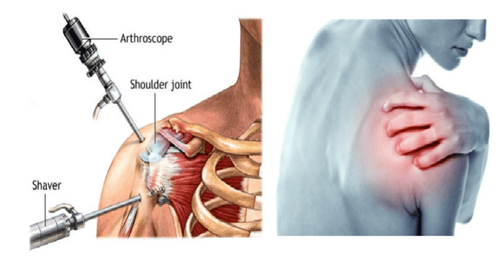 Application of shoulder arthroscopy in the diagnosis and treatment of adhesions (freeze) of the shoulder joint