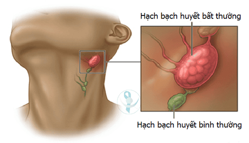 
Cắt bỏ một hạch bạch huyết để chẩn đoán bệnh ung thư ở cổ
