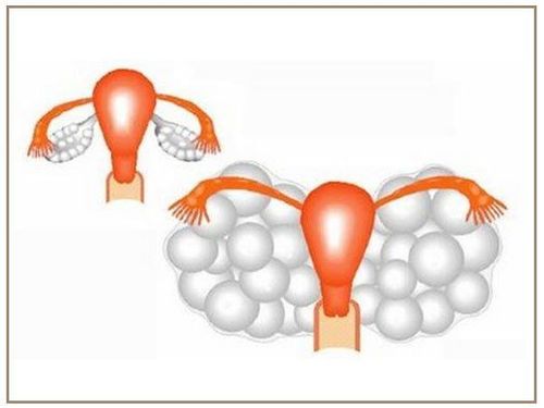 
Hiện tượng quá kích buồng trứng
